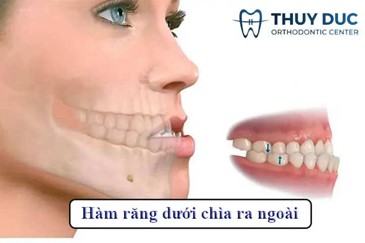 Tướng Cằm Chìa Ra Ngoài