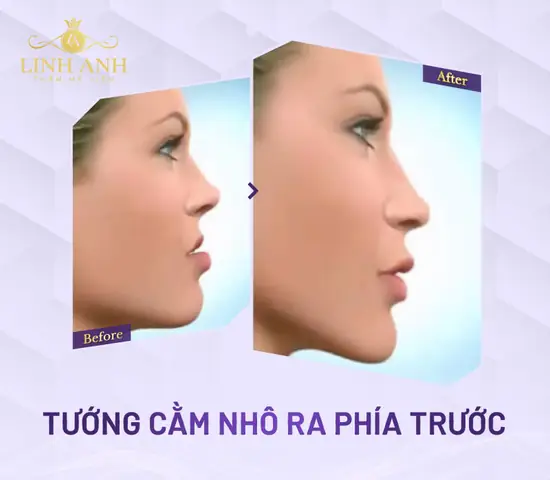 Tướng Cằm Nhô Ra Tướng Cằm Nhô Ra