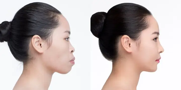 Tướng Cằm Nhô Ra Phía Trước