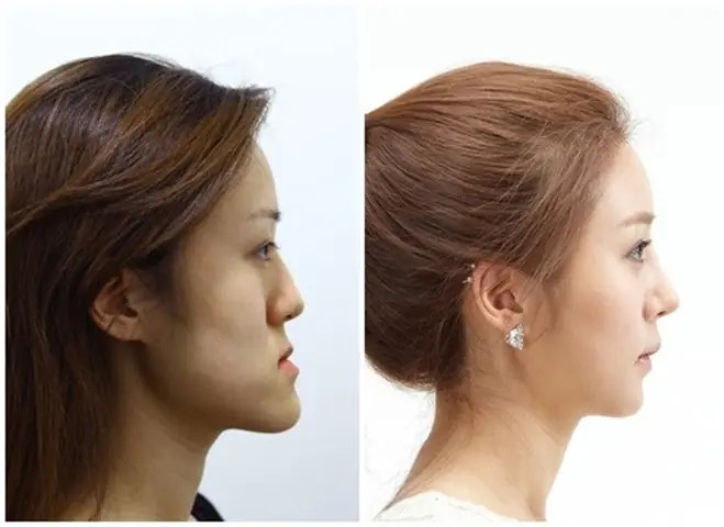 Tướng Cằm Nhô Ra Phía Trước