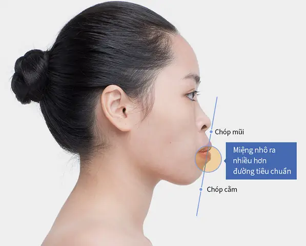 Tướng Cằm Nhô Ra Phía Trước