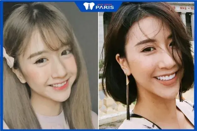 Tướng Cằm Nhô Xương Tướng Cằm Nhô Xương