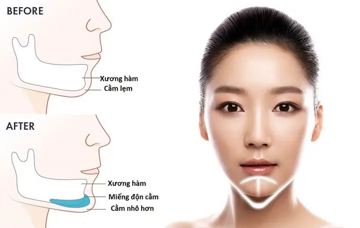 Tướng Cằm Nhô Xương Tướng Cằm Nhô Xương