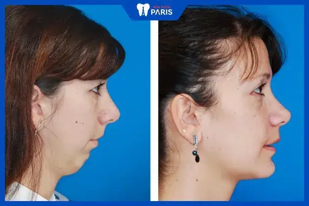 Tướng Cằm Nhô Xương
