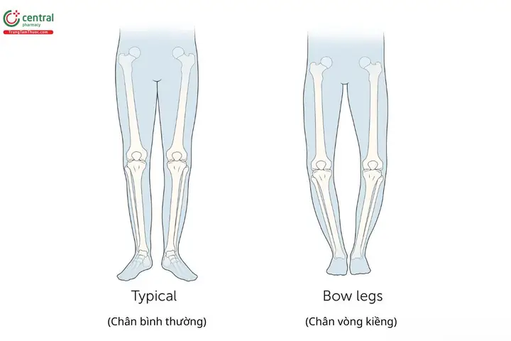 Tướng Chân Vòng Kiềng Tướng Chân Vòng Kiềng
