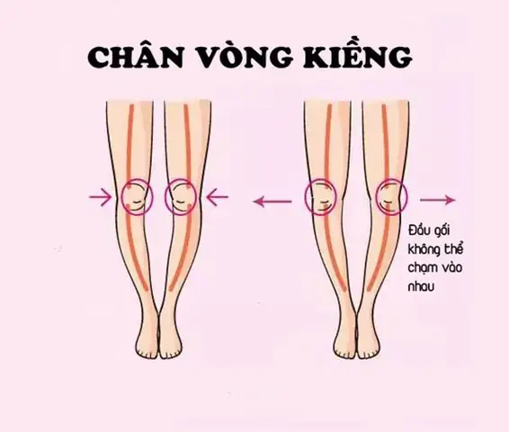 Tướng Chân Vòng Kiềng Tướng Chân Vòng Kiềng