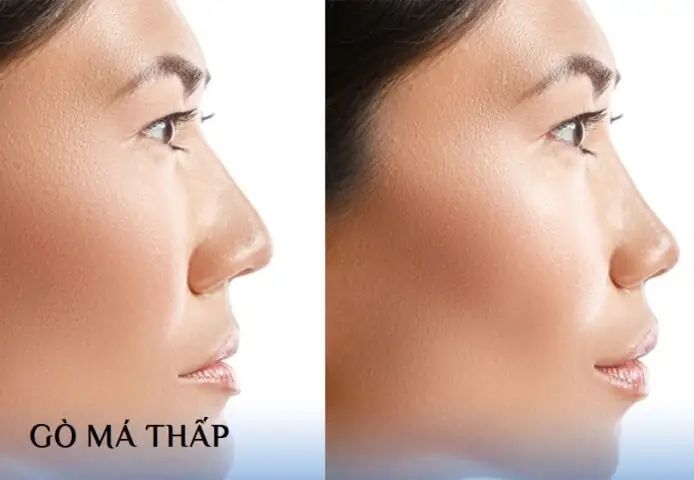 Tướng Gò Má Thấp Tướng Gò Má Thấp