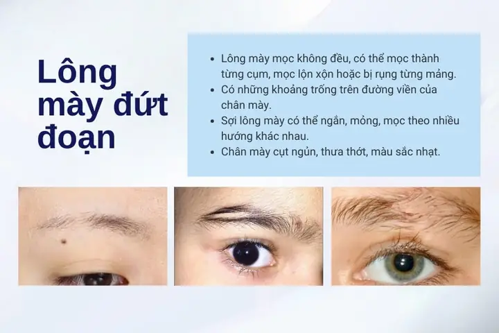 Tướng Lông Mày Bị Đứt Đoạn