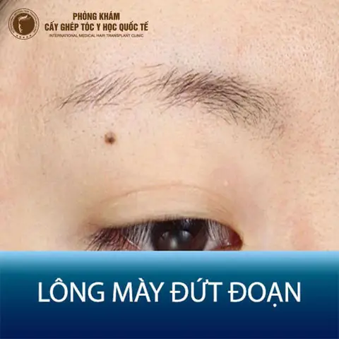 Tướng Lông Mày Bị Đứt Đoạn Tướng Lông Mày Bị Đứt Đoạn