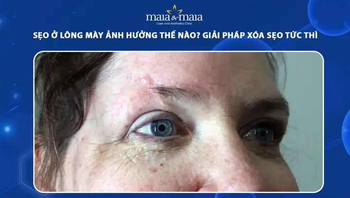 Tướng Lông Mày Có Sẹo Tướng Lông Mày Có Sẹo