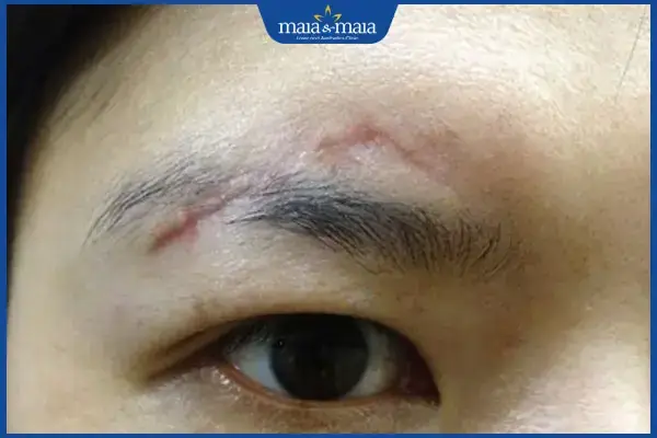 Tướng Lông Mày Có Sẹo