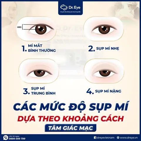 Tướng Mắt 1 Mí Sụp