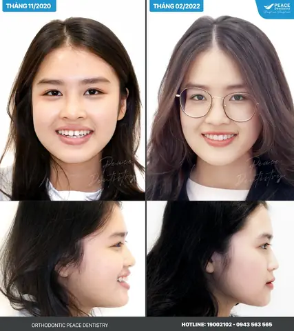 Tướng Mặt Bên To Bên Nhỏ