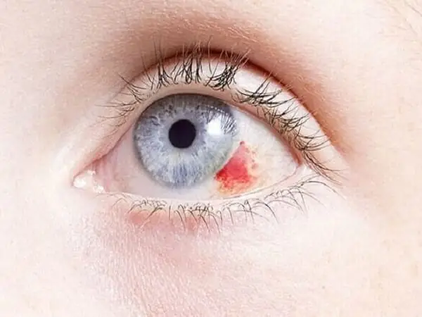 Tướng Mắt Có Tia Máu Đỏ