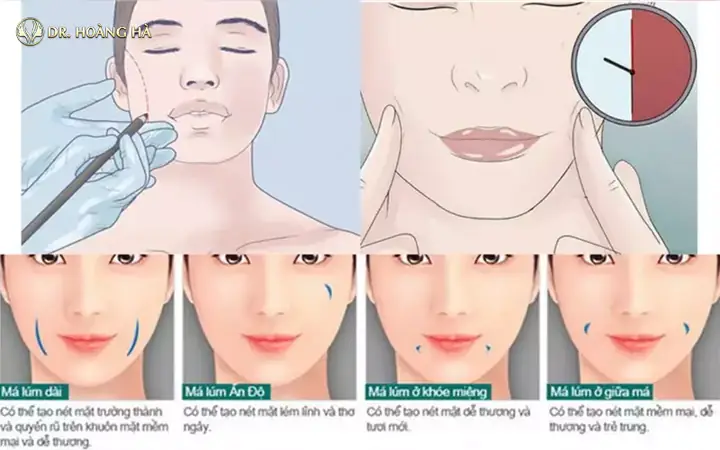 Tướng Mặt Lúm Đồng