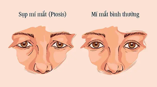 Tướng Mắt Sụp Mí Tướng Mắt Sụp Mí