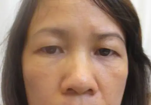 Tướng Mắt Sụp Mí