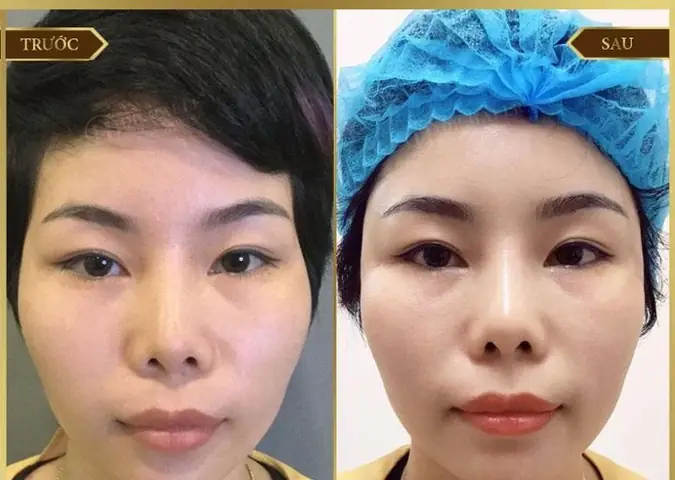 Tướng Mặt Thái Dương Hopa