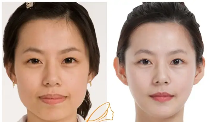 Tướng Mặt Thái Dương Hopa