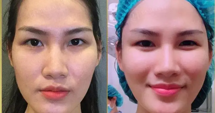 Tướng Mặt Thái Dương Hopa