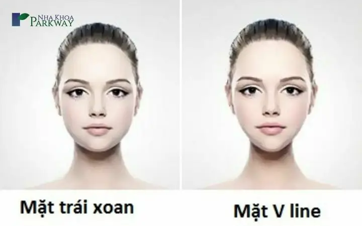 Tướng Mặt V Line