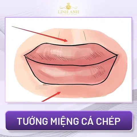 Tướng Miệng Cá Chép Tướng Miệng Cá Chép