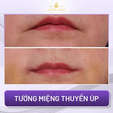 Tướng Miệng Phụ Nữ