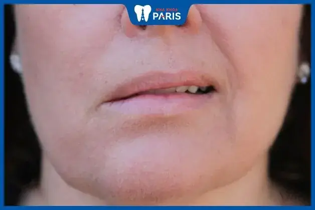 Tướng Môi Bị Méo