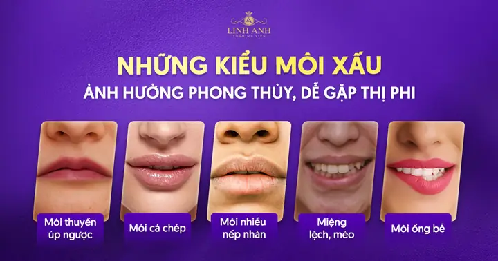 Tướng Môi Bị Méo