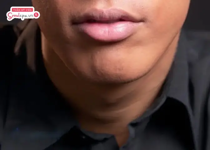 Tướng Môi Cá Trê