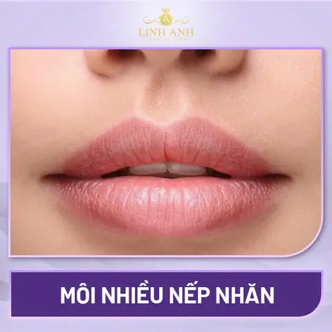 Tướng Môi Nhiều Nếp Nhăn