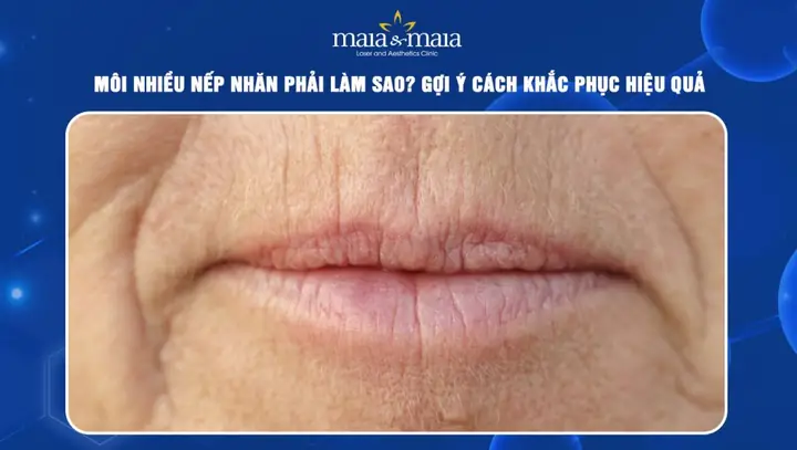 Tướng Môi Nhiều Nếp Nhăn