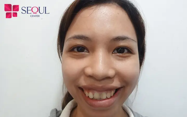 Tướng Môi Túi Vải