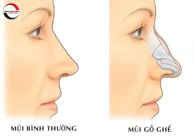 Tướng Mũi Cao Nhọn Tướng Mũi Cao Nhọn