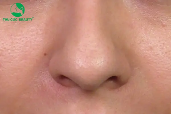 Tướng Mũi Củ Tỏi Tướng Mũi Củ Tỏi