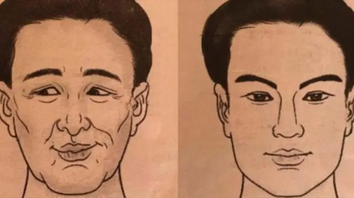 Tướng Mũi Gấp Khúc