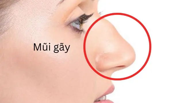 Tướng Mũi Gãy Phụ Nữ