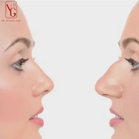 Tướng Mũi Gồ Ghề Tướng Mũi Gồ Ghề