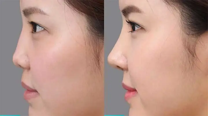 Tướng Mũi Hếch Phụ Nữ