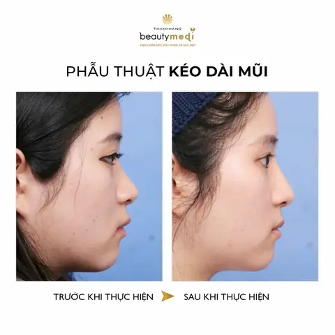 Tướng Mũi Tẹt Hếch Tướng Mũi Tẹt Hếch