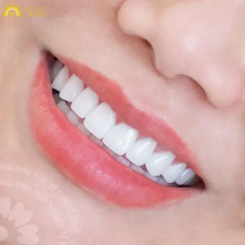 Tướng Răng 32 Chiếc