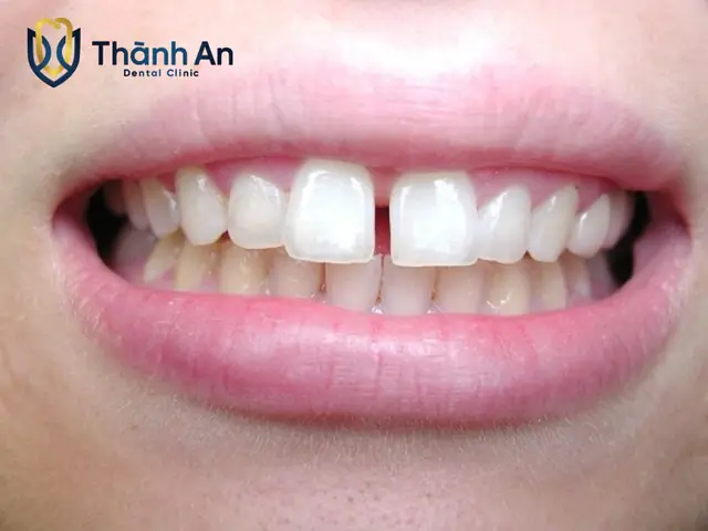 Tướng Răng Cửa Hở