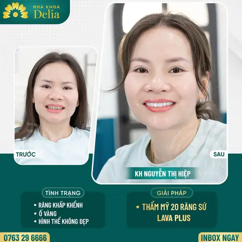 Tướng Răng Khấp Khểnh