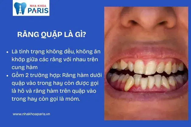 Tướng Răng Quặp Vào Trong