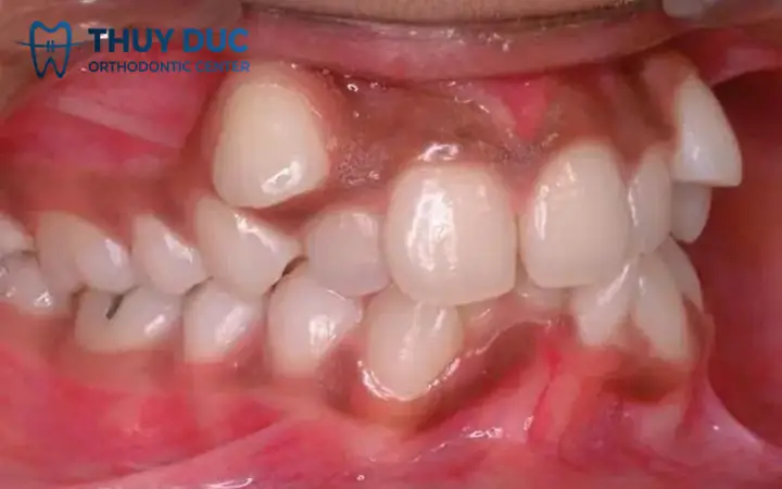 Tướng Răng Thưa Và Không Đều