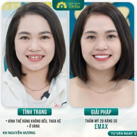 Tướng Răng Thưa Và Không Đều