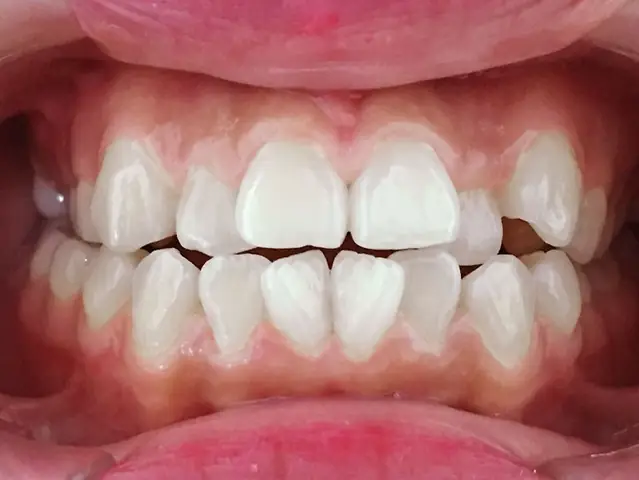 Tướng Răng Thưa Và Không Đều