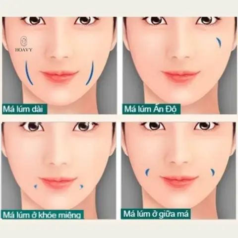 Tướng Số Của Người Có Má Lúm Đồng Tiền