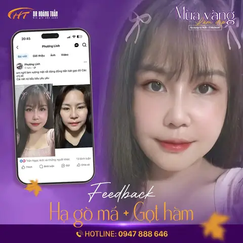 Tướng Số Khi Hạ Gò Má