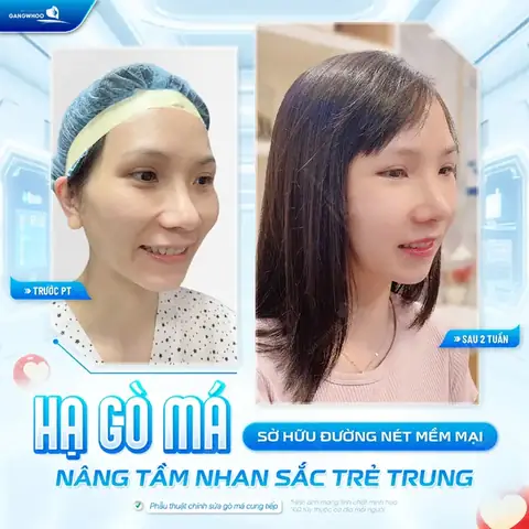 Tướng Số Khi Hạ Gò Má